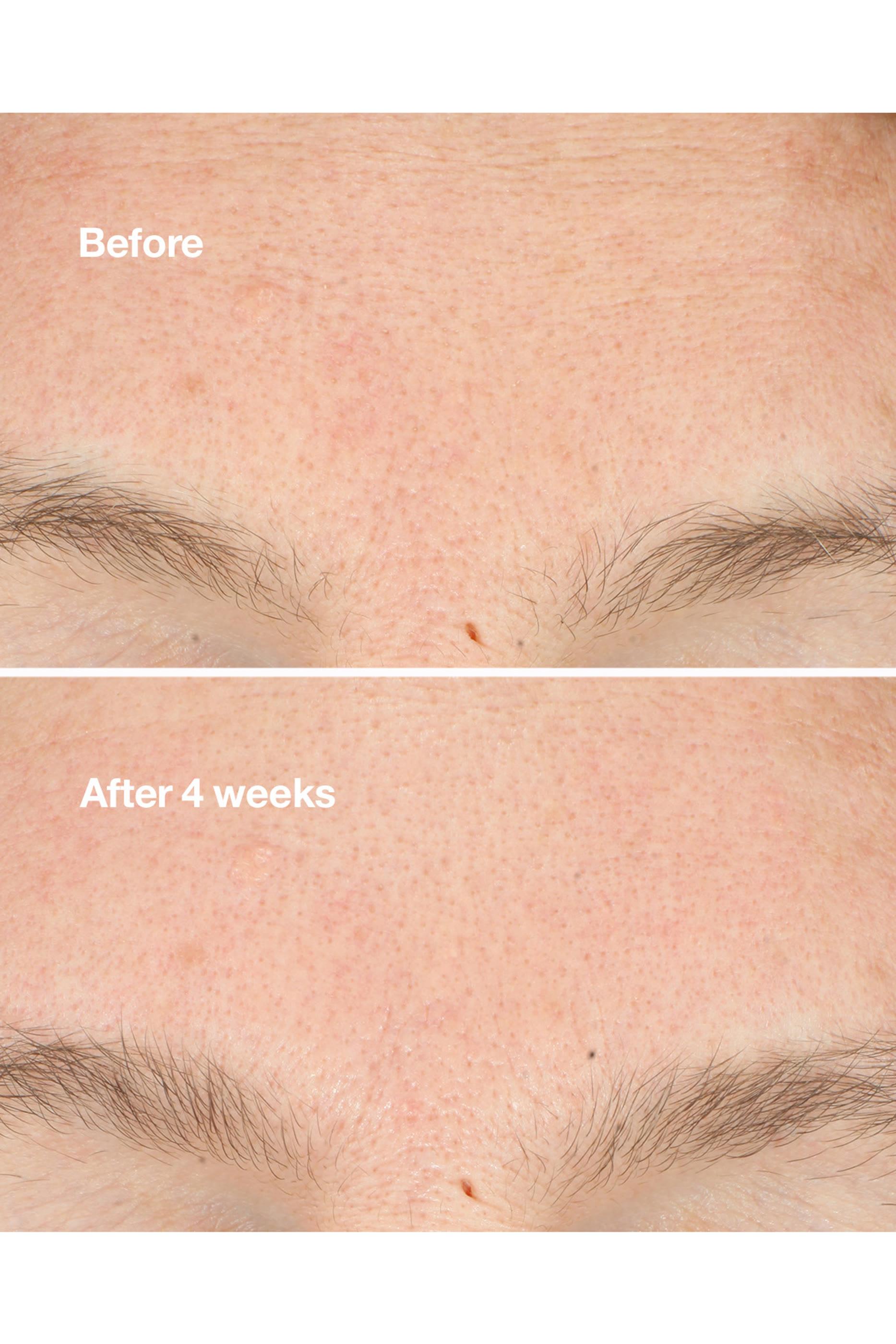 Clarifying Do-Over Peel